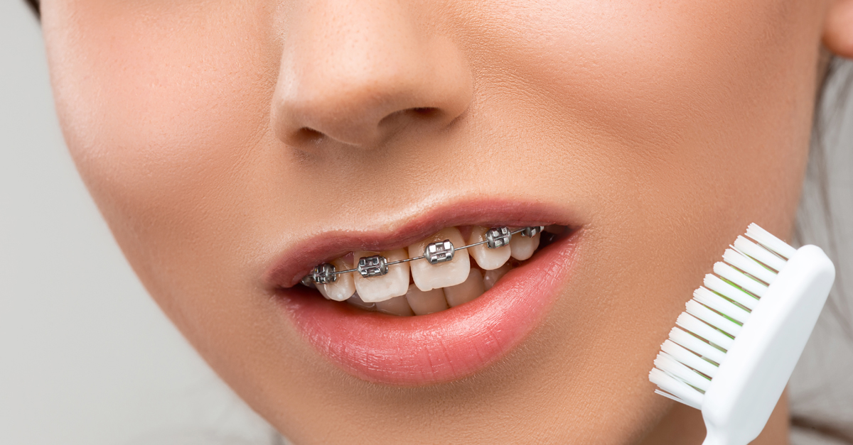 6 pasos para limpiar tus dientes si llevas brackets